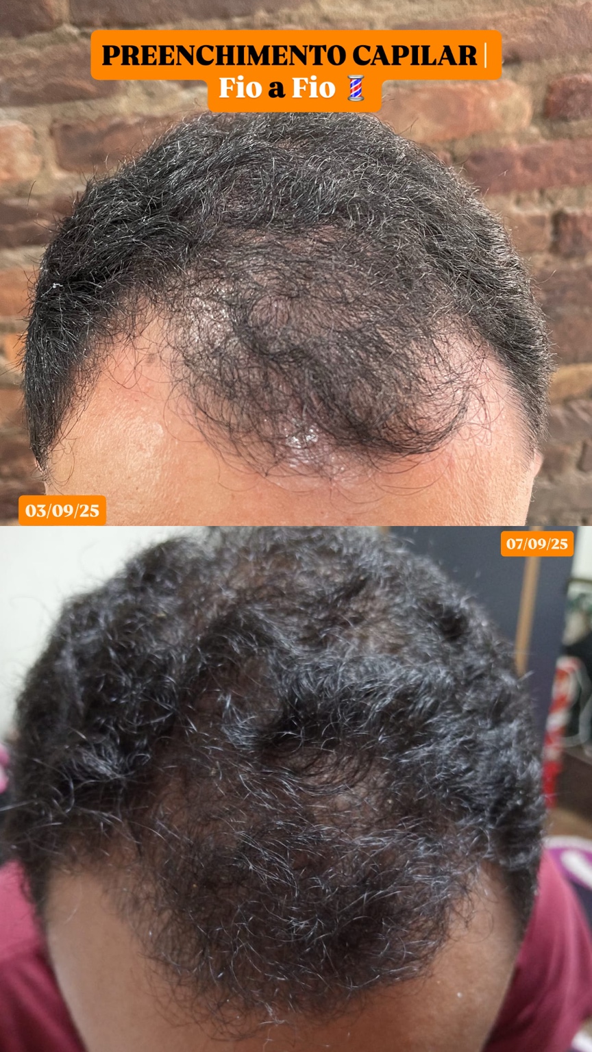 Capilar fio a fio - caso 1