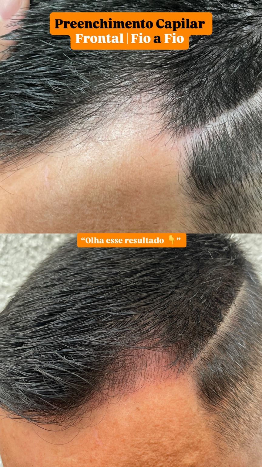 Capilar fio a fio - caso 2