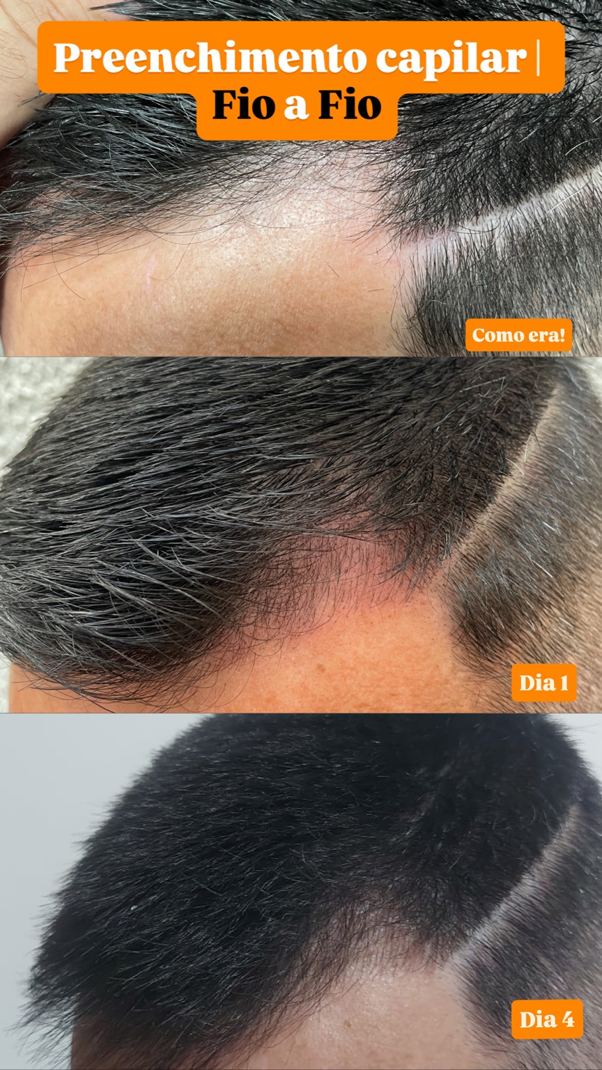 Capilar fio a fio - caso 3