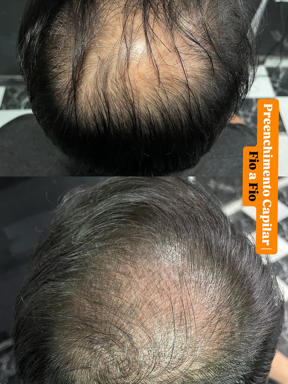 Capilar fio a fio - caso 4