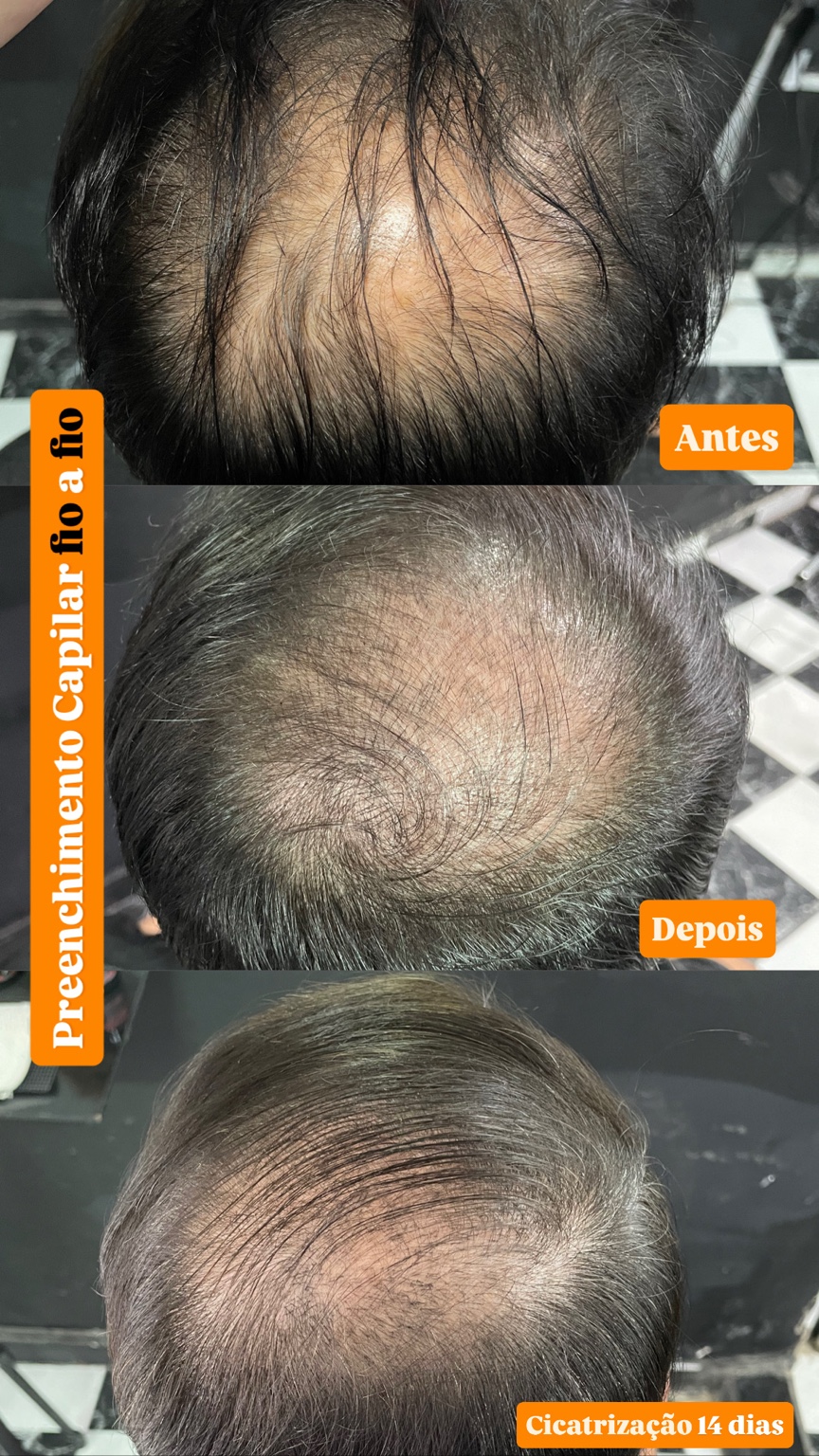 Capilar fio a fio - caso 5