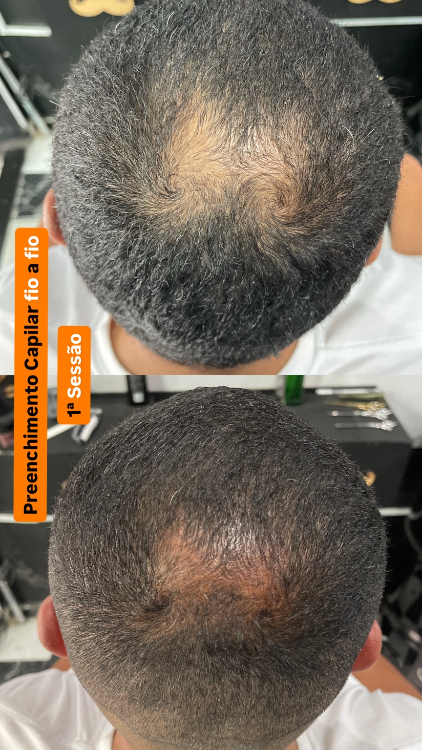 Capilar fio a fio - caso 6