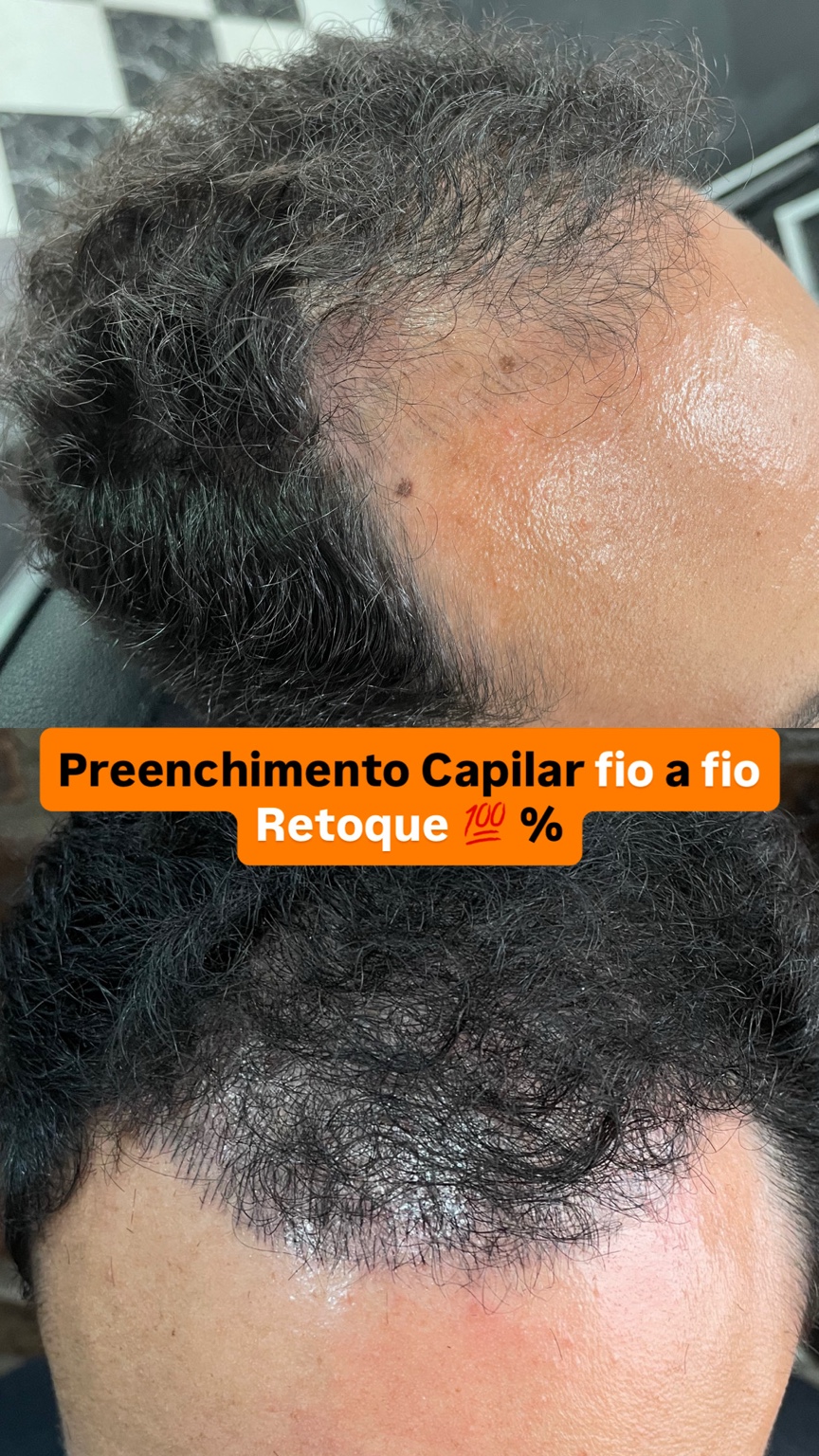 Capilar fio a fio - caso 7